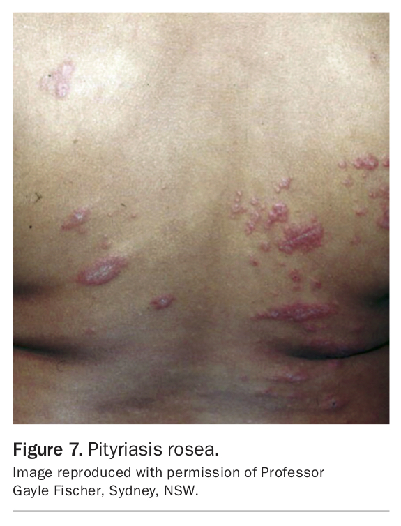 Discoid eczema more than just dermatitis Medicine Today